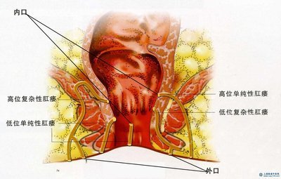 中医治疗肛瘘