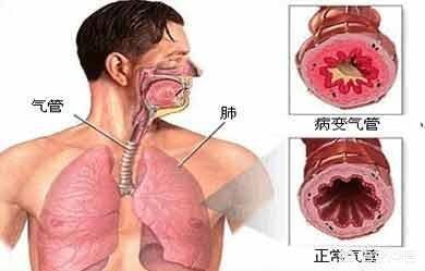 支气管扩张康复病例