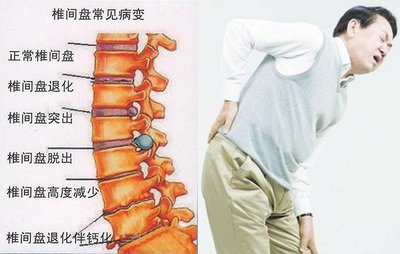 中医治疗腰椎间盘突出症